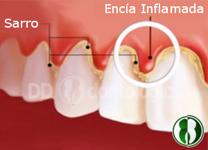 Sangrado de encias, gingivitis