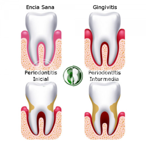 Sangredo de encias, Gingivitis