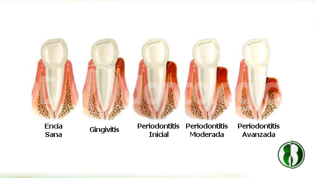 Sangrado de encias, Gingivitis