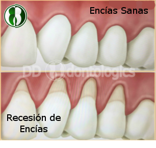 Sangrado de encías, Gingivitis