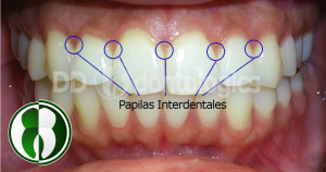 Papilas Interdentales