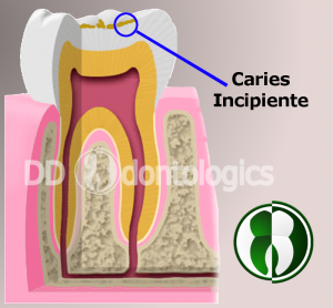 Caries Incipiente