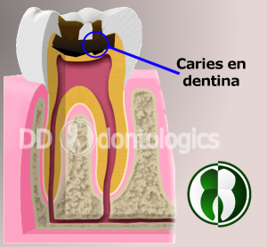 Caries en dentina