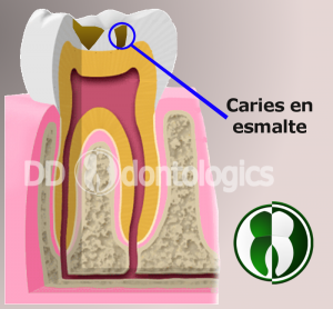 Caries en esmalte
