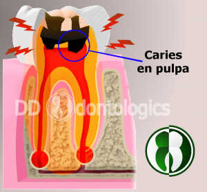 Caries en pulpa