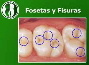 Focetas y Fisuras