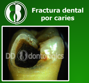 Fractura por caries