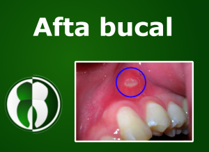Afta Bucal