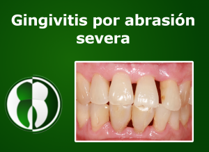 Gingivitis por abrasion severa