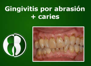 Gingivitis por abrasion + caries
