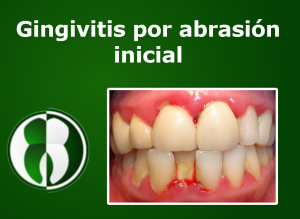 Gingivitis por abrasión inicial