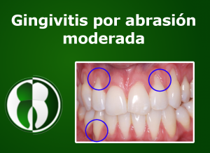 Gingivitis por abrasion moderada