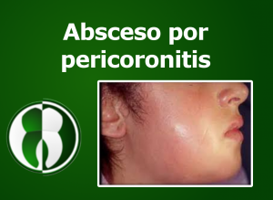 Absceso por pericoronitis