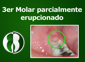Molar parcialmente erupcionado