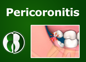 Pericoronitis